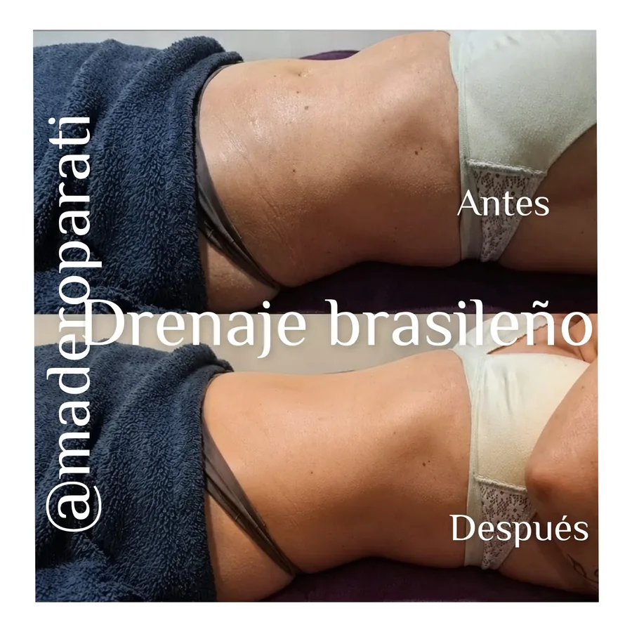 Antes y después de una sesión de drenaje brasileño en el abdomen